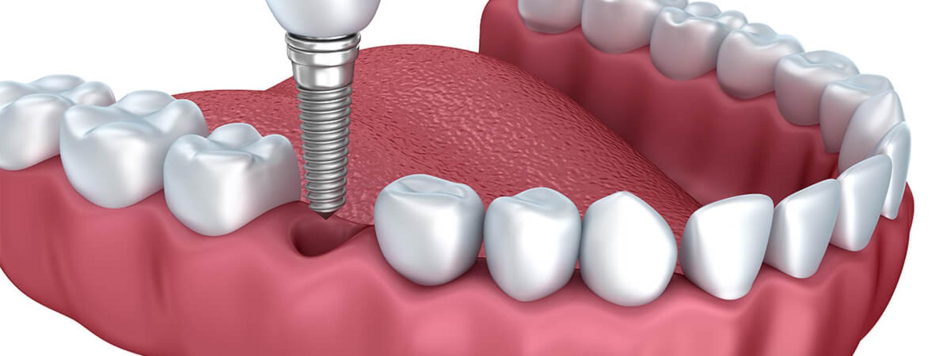 Cosmetic Tooth Replacement in Beverly Hills CA Area Cosmetic Tooth Replacement in Beverly Hills CA Area