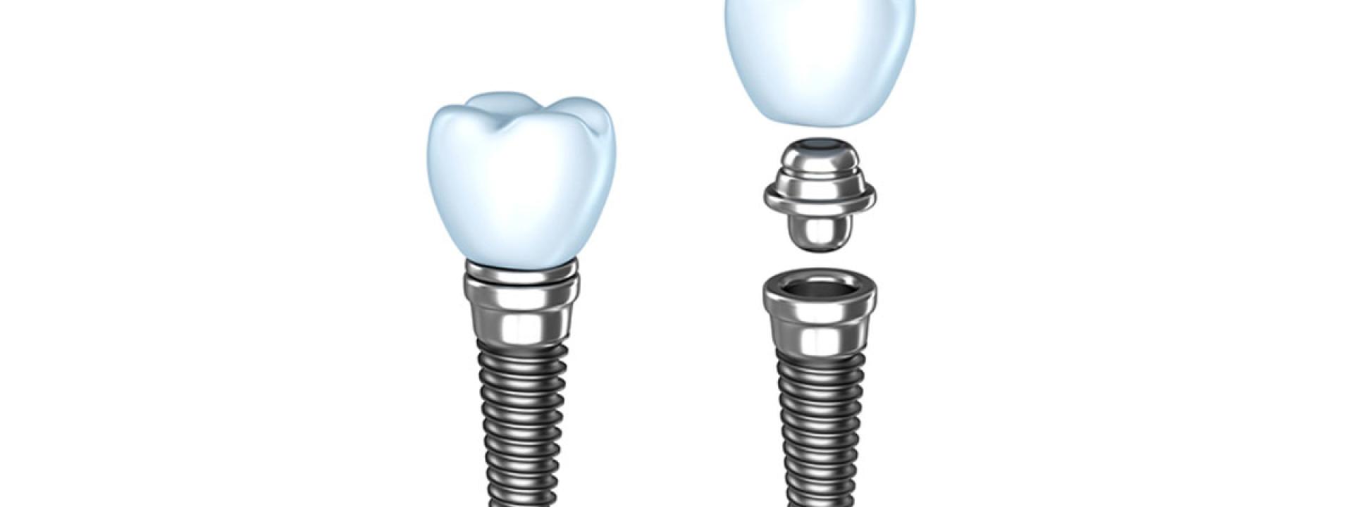 Dental implants Dental implants