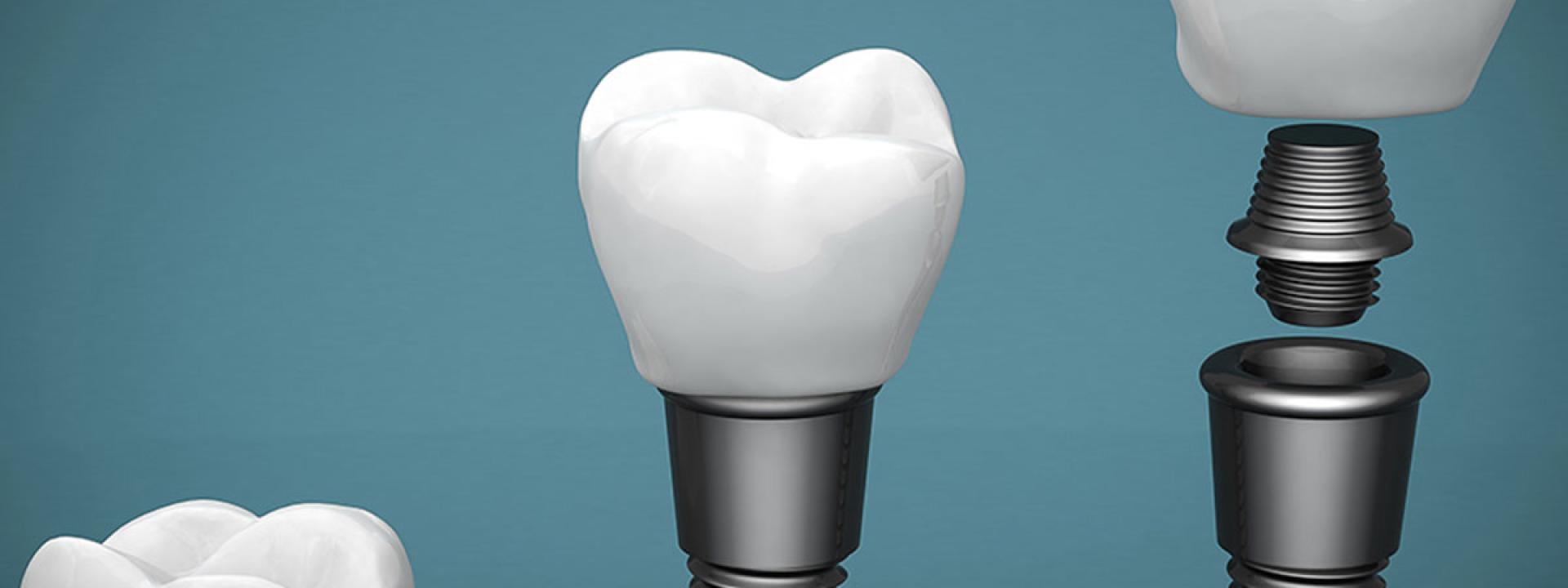 Implants Implants