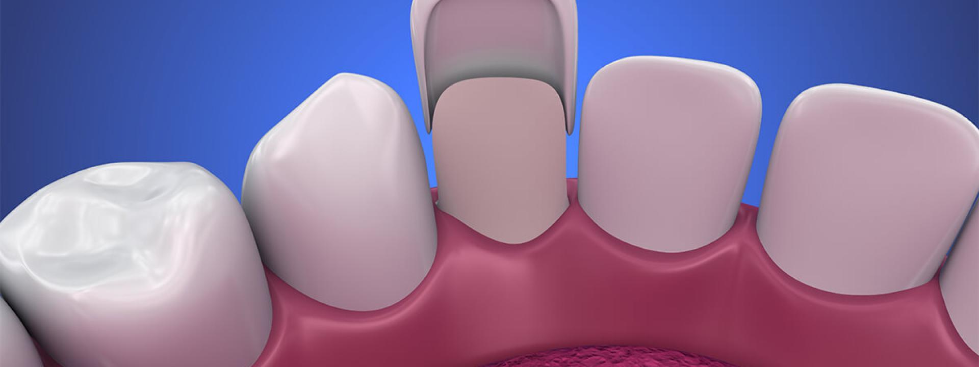 Veneers for Gaps in Teeth Beverly Hills CA Area Veneers for Gaps in Teeth Beverly Hills CA Area