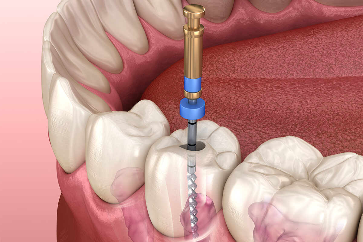 Root Canal Infection Treatment in Beverly Hills CA Area